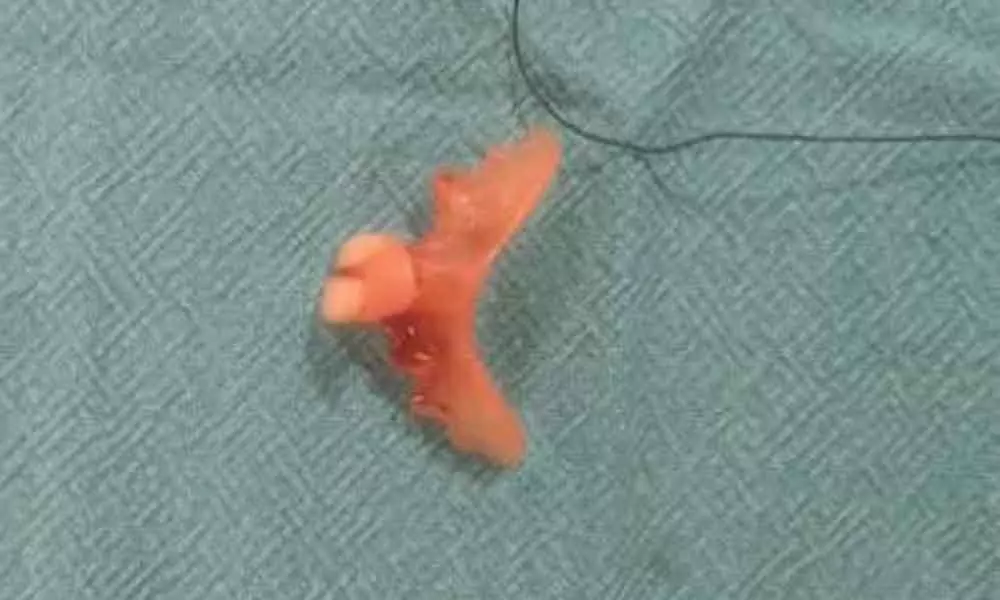 Doctors remove tooth denture stuck in throat
