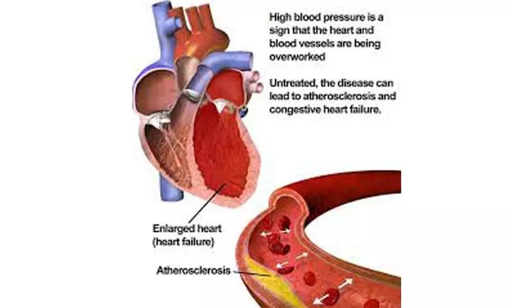 Hypertension a major cause for concern
