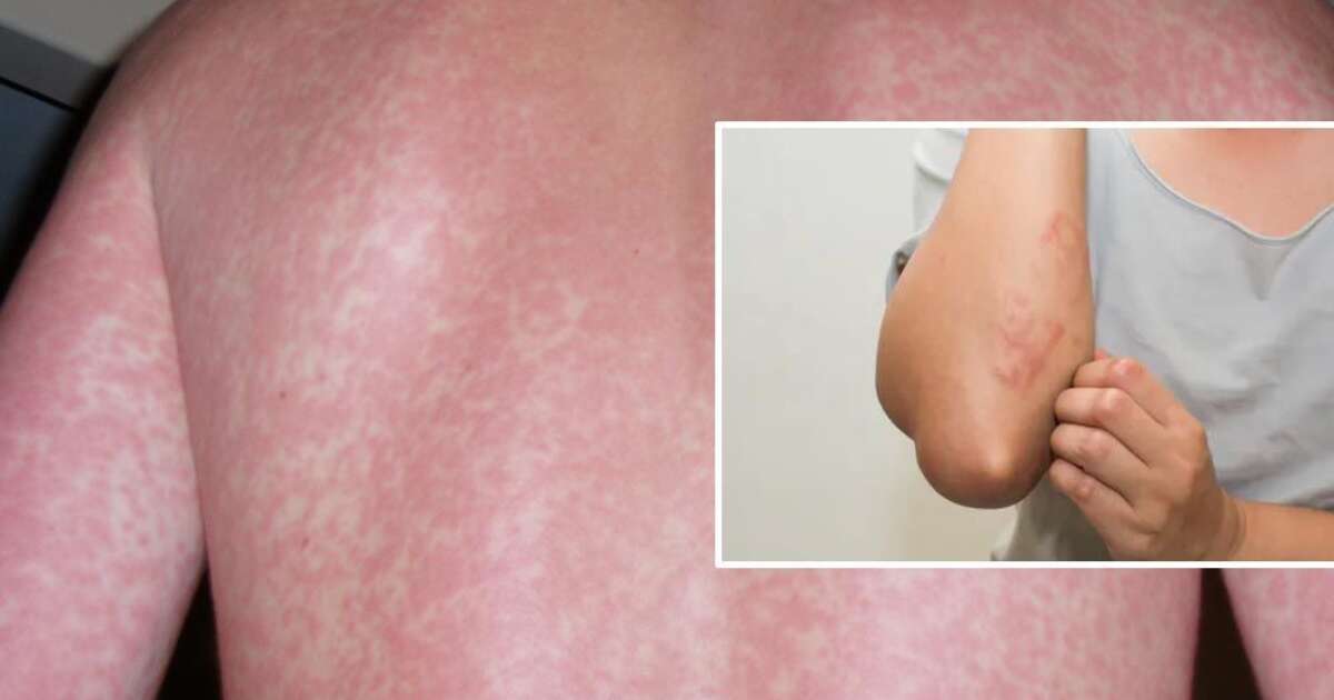 What is a Viral rash? And when to see a Doctor?
