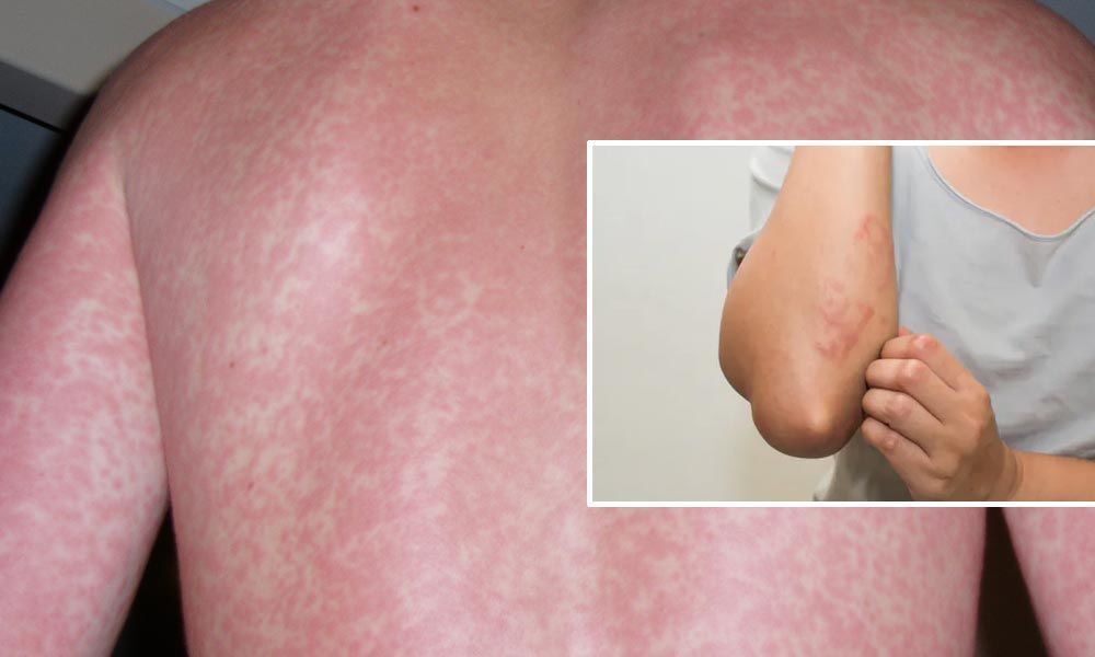 What Is A Viral Rash And When To See A Doctor 