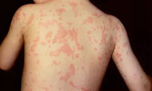 CCMB study throws light on auto inflammation