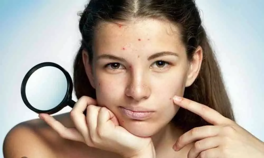 Lets understand  Acne Map