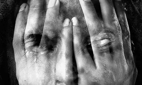 UP: Girl throws acid on boyfriend after he refuses to marry her