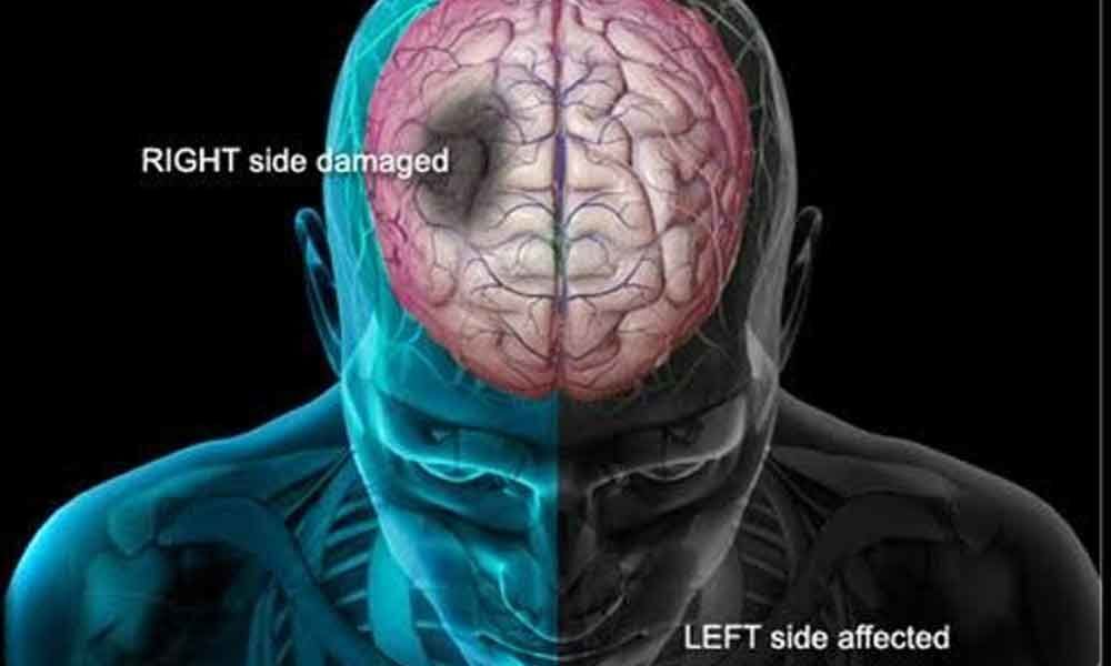 Left Side Stroke Damage