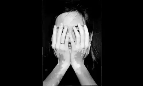 Hyd Unani hospital balm for Vitiligo