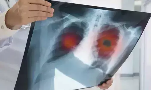 AI to determine if immunotherapy is working in lung cancer