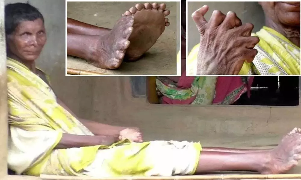 Odisha woman house arrested and called witch for being born with 20 toes, 12 fingers