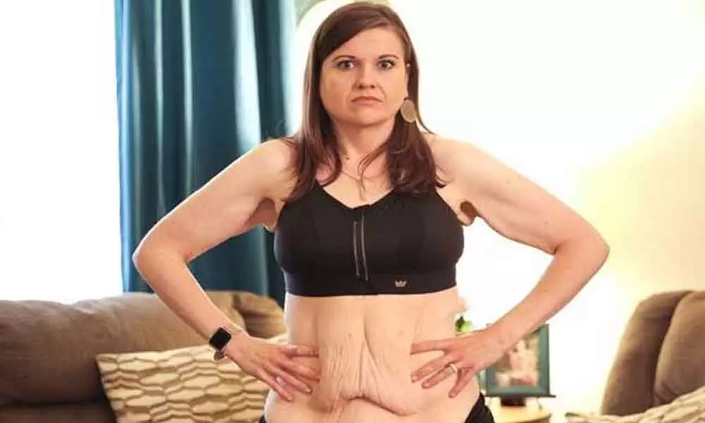 US woman who shed weight left with 9 kg excess skin