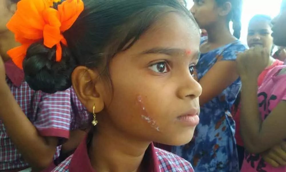 Kamareddy: 82 students got itchy rash on skin