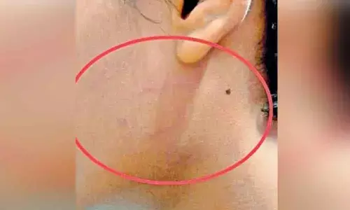 Class 10 injured after being hit by teachers in Hyderabad