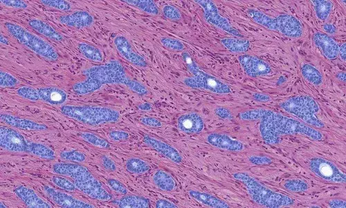 AI can detect blood cancer with high reliability