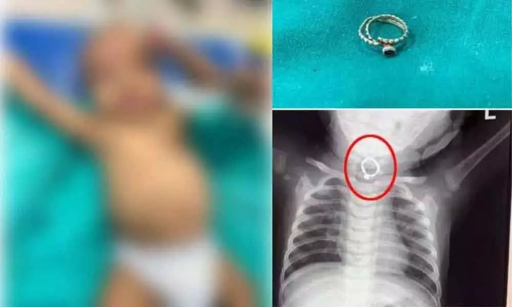 Doctors remove ring from five-month-olds throat in Nizamabad