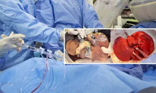 Machine keeps human livers alive for a week outside body
