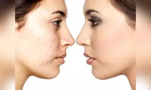 Simple Home Remedies To Get Rid Of Blemishes At Home