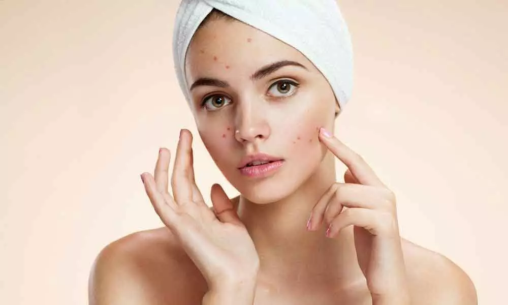 Dealing with acne breakout