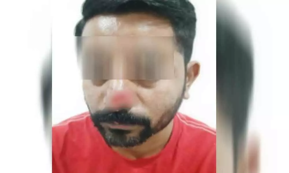 Hyderabad: Man booked for biting friends nose over financial dispute