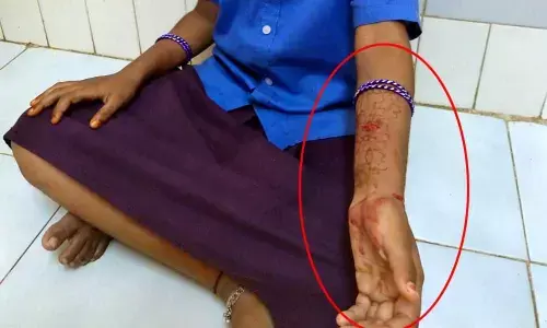 Monkey attacks on students in Vizianagaram district