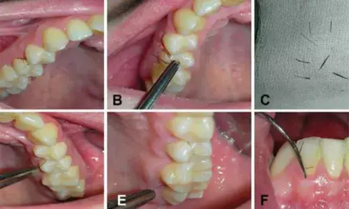 Eyelashes has Grown in an Italian Womans Mouth, Doctors said PCOS is the Reason