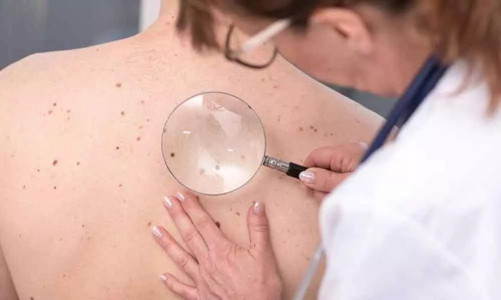 Sydney: New technique to improve melanoma detection, treatment