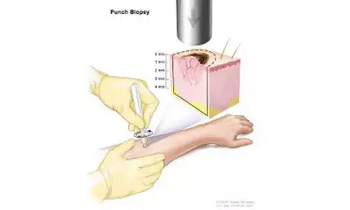 Novel way to detect, treat skin cancer developed