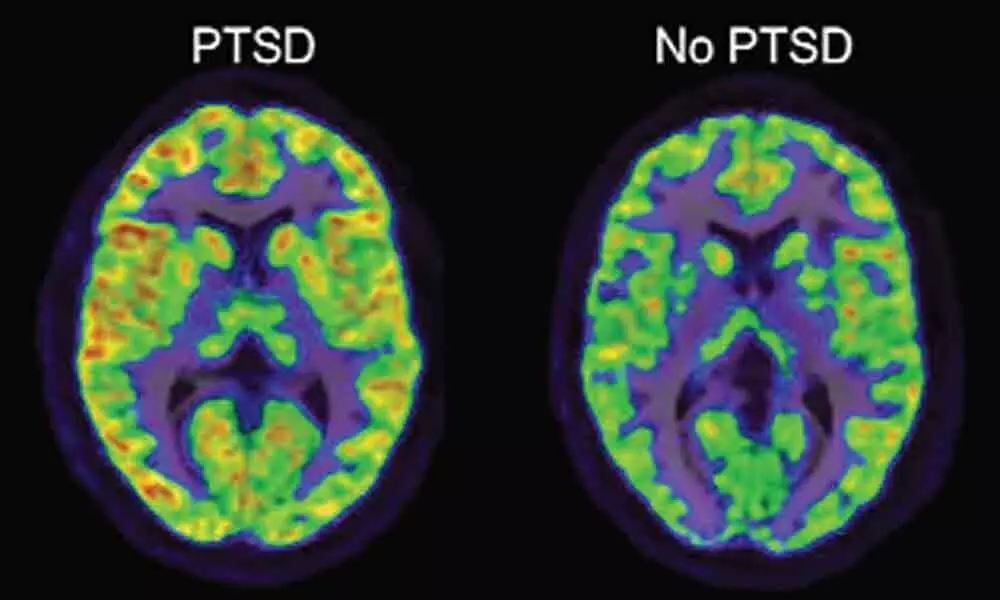 Study finds novel potential therapy for childhood brain tumours