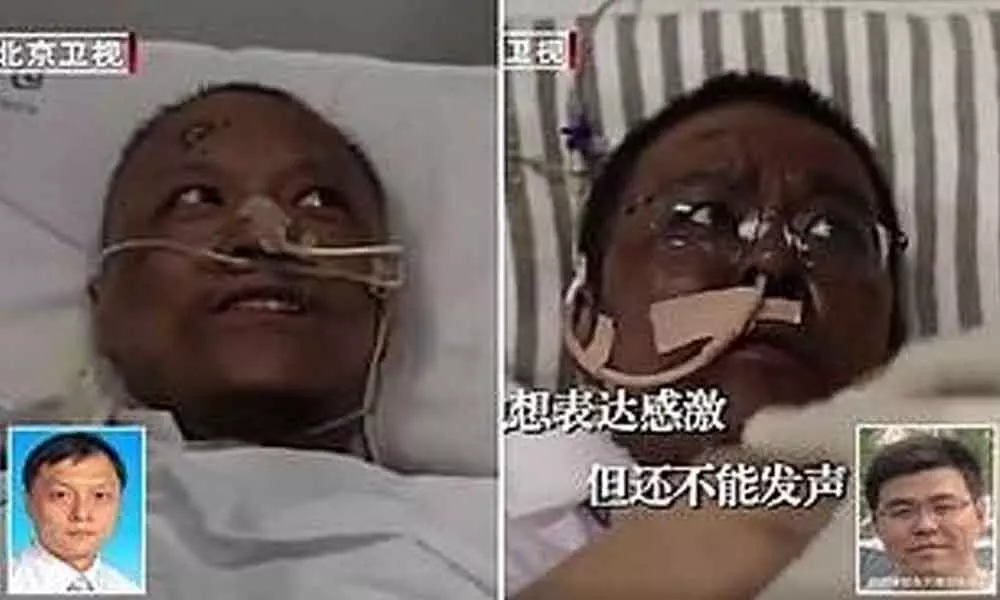 Skin of 2 Chinese doctors infected with COVID-19 turned dark