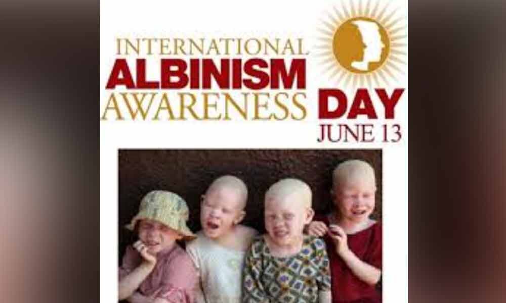 International Albinism Awareness Day 2020: Theme, History and ...