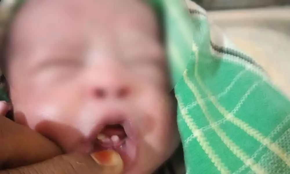 Baby born with teeth in Gadwal