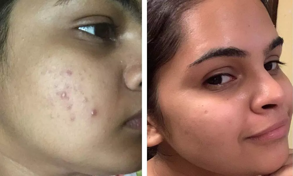 Tollywood Actress Vidyullekha Ramans Skin Before And After Weight Loss