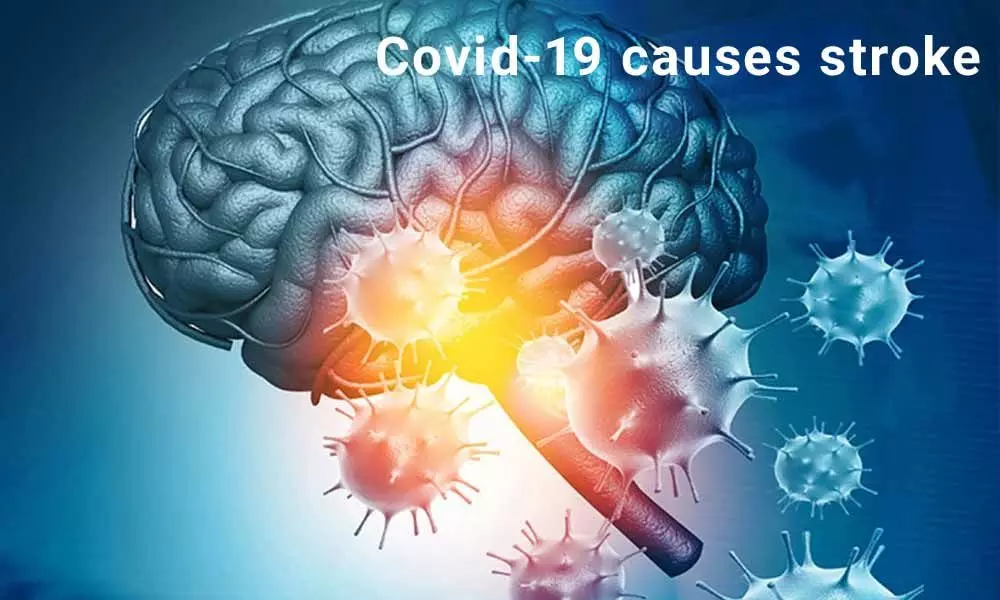 Theres proof Coronavirus causes stroke in absence of comorbidities: Neurologists