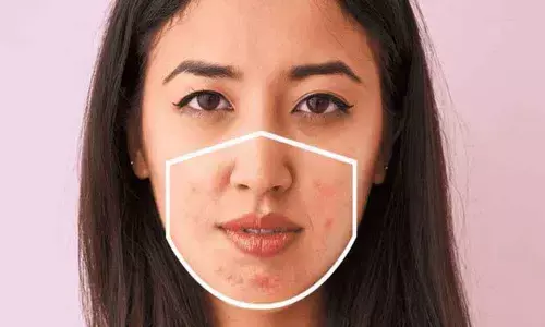 Do you have a case of Maskne?