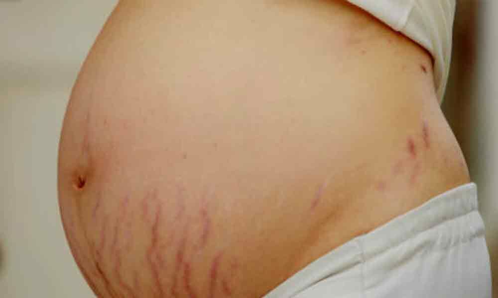 How To Manage Stretch Marks During And Post Pregnancy