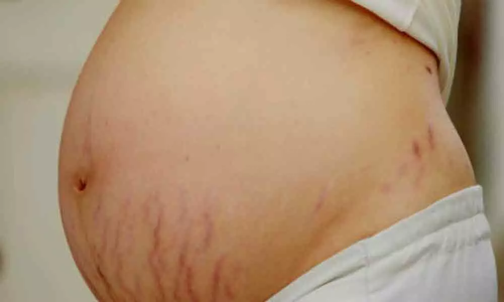 How to manage stretch marks during and post-pregnancy