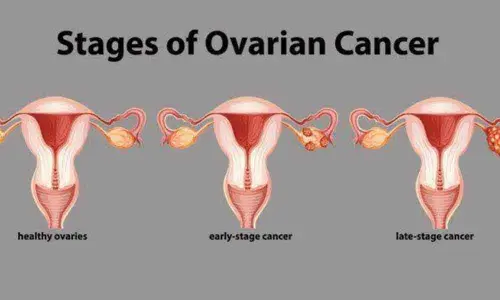 Ovarian Cancer
