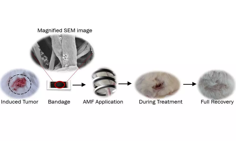 IISc researchers develop bandage to kill cancer cells
