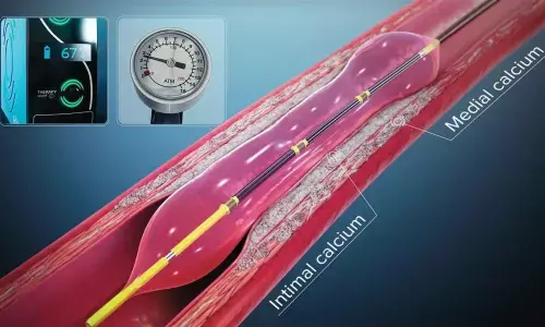 IVL proves boon for doctors to treat calcified coronary blocks