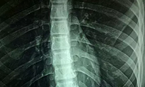 Coronavirus patients with spinal fractures twice as likely to die: Study