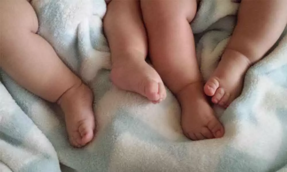 Conjoined twins separated in UP