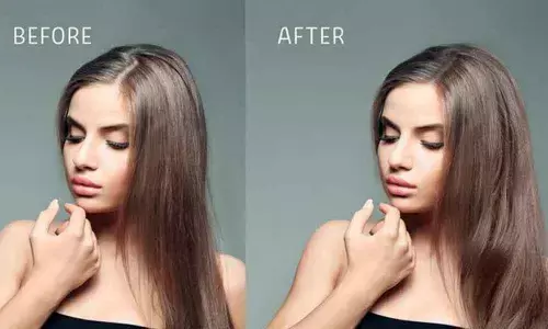 Experts bust myths about hair transplantation