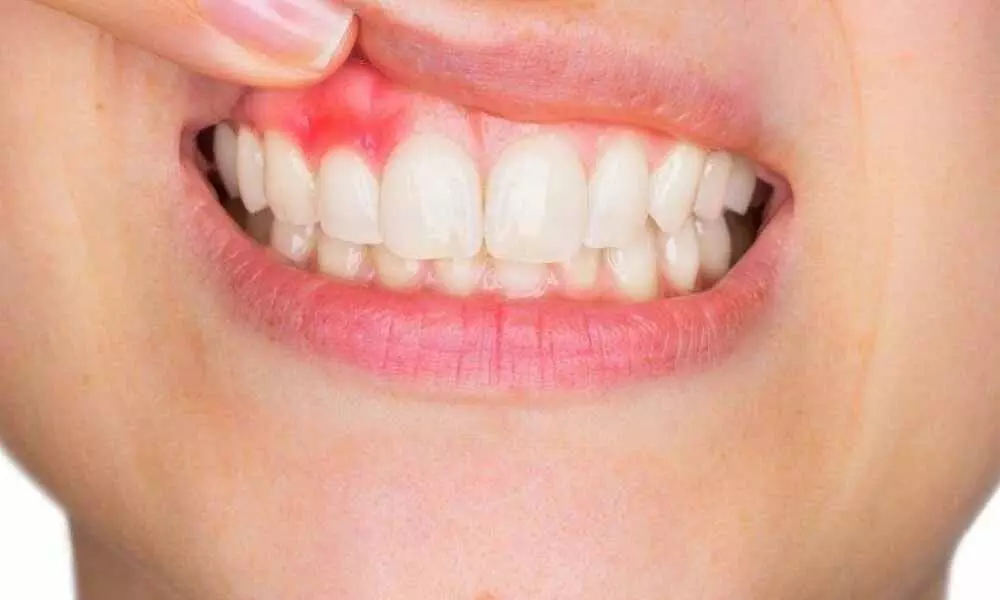 Bleeding gums may indicate vitamin C deficiency