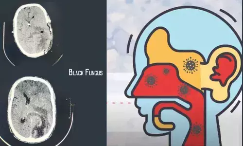 Black Fungus treatment confined to multi-speciality hospitals