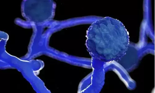 Covid Associated Mucormycosis