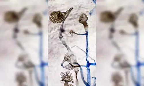 Hyderabad: Mahabubnagar man dies of black fungus