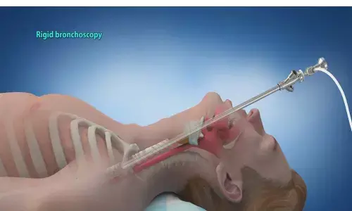 Rare Rigid Bronchoscopy procedure saves life of 40 year old Tobacco chewer