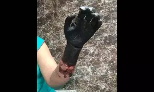 Gurugram hospital under scanner after womans hand turns black