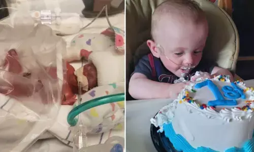 World’s Most Premature Baby Survived And Hold The Guinness World Record