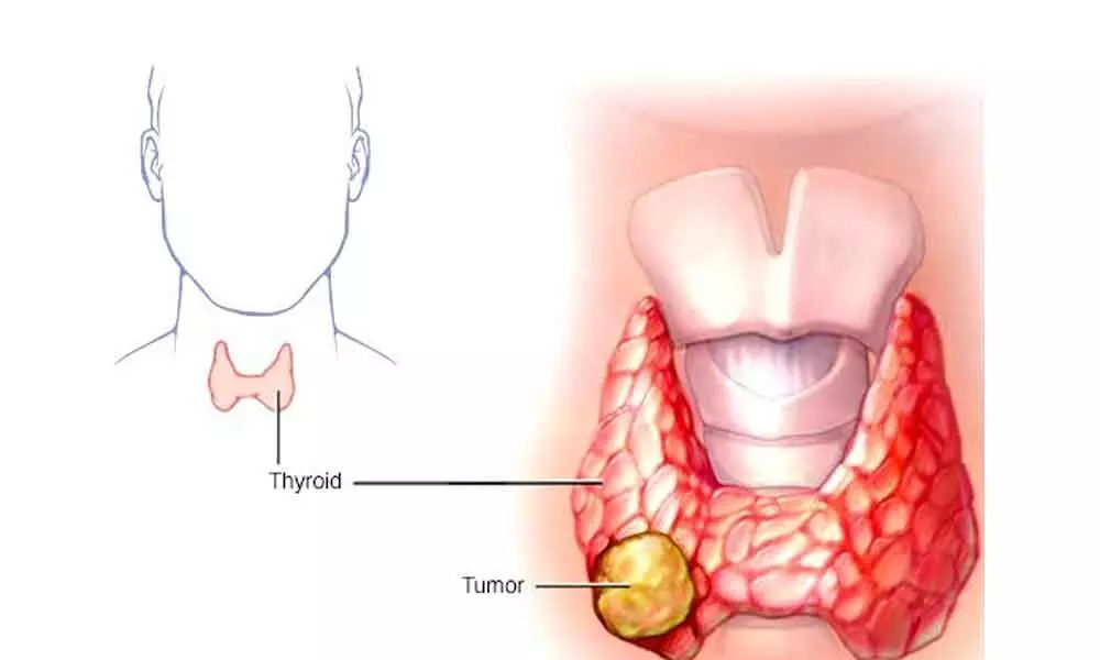 Thyroid Cancers Can Be Detected Early