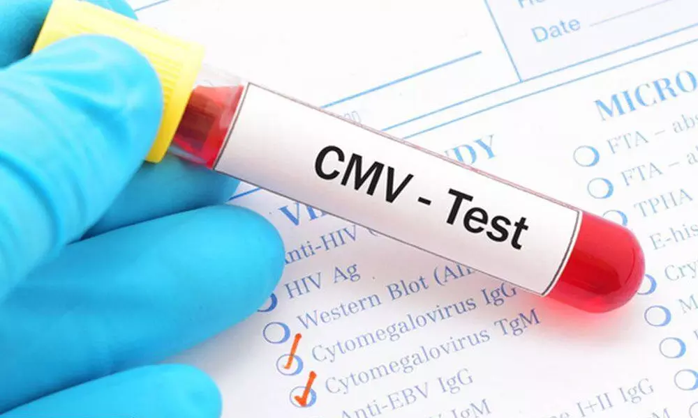 Cytomegalovirus Test