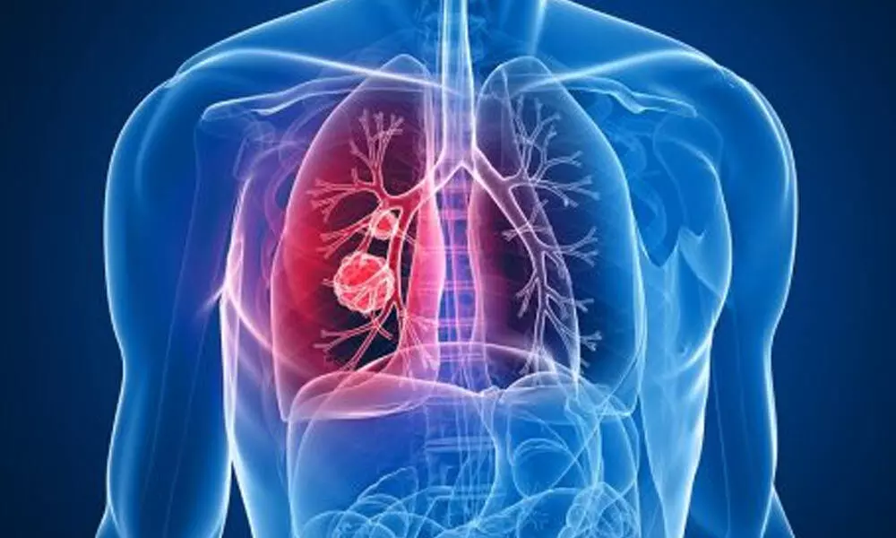 Lung cancer incidence rising among women, say experts