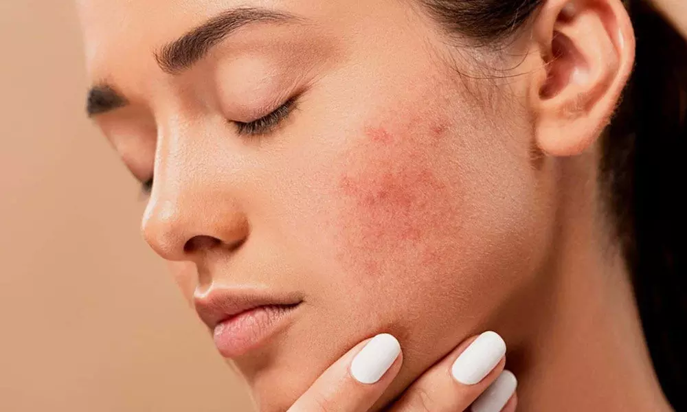 Home remedies to fight hormonal acne